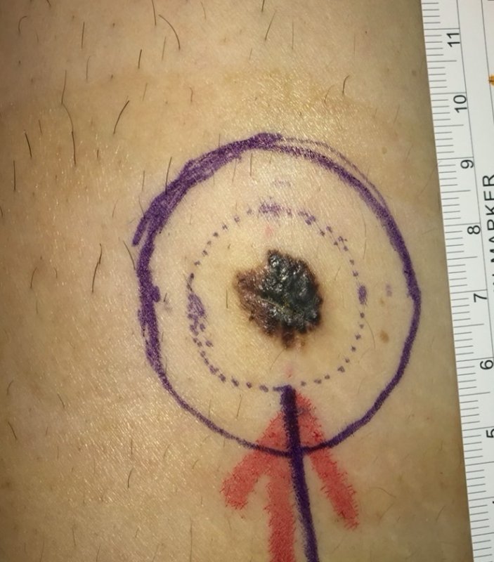 高雄一名76歲林姓婦人，長期因腳趾甲旁紅腫化膿與肉芽增生，誤以為是慢性甲溝炎，輾轉就醫一年未癒，直到前往高雄醫學大學附設中和紀念醫院，才被確診為惡性程度極高的「肢端黑色素瘤」。(漾新聞記者陳雯萍翻攝)