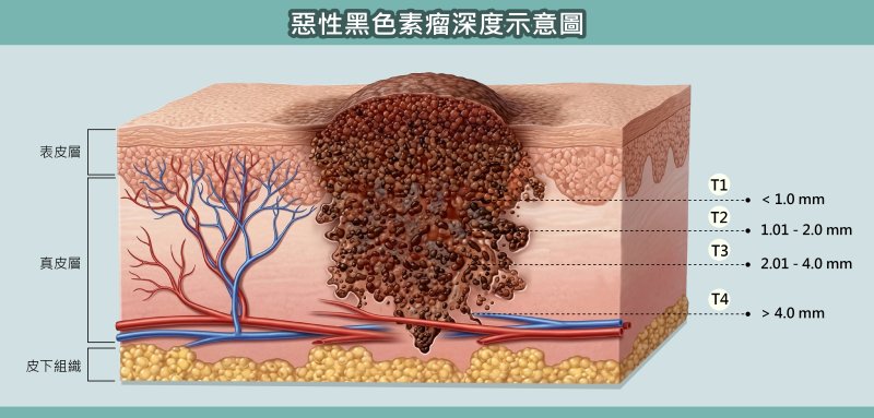 高雄醫學大學外科部長李書欣說明，甲溝炎多為細菌或黴菌感染所致，若肉芽腫長期未癒，或出現顏色異常、形狀不規則、出血與疼痛等情形，應提高警覺，及早就醫排除惡性病變。